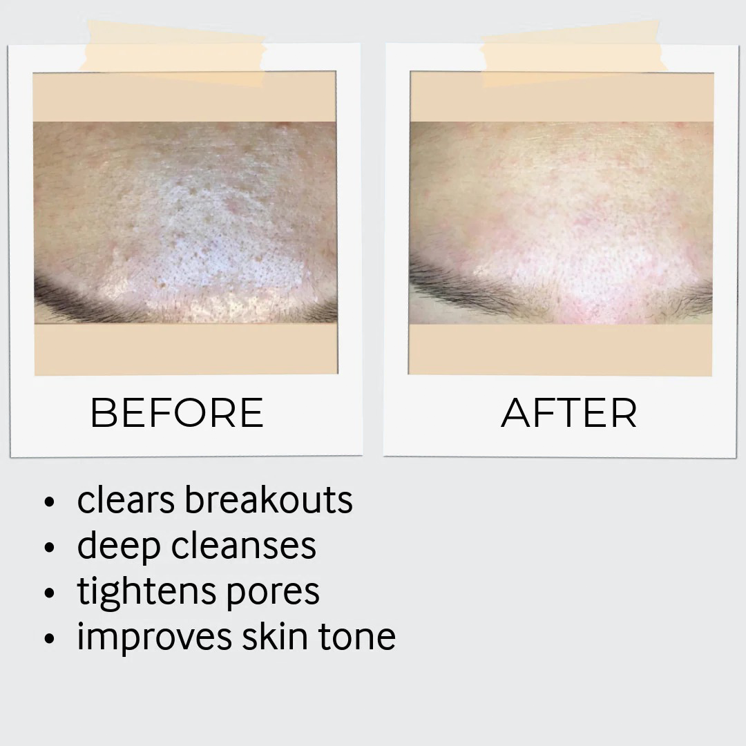 Exfoliation Bundle