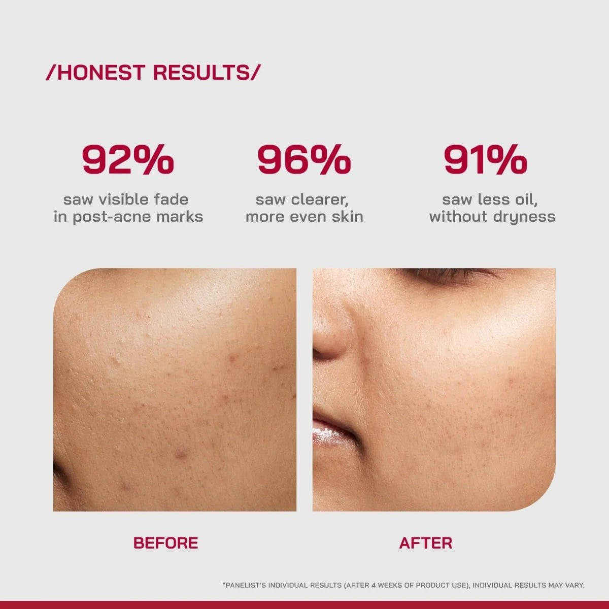 Acne Pro Serum