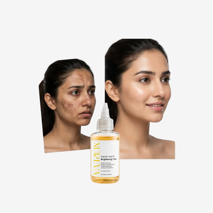 Acne Care Bundle