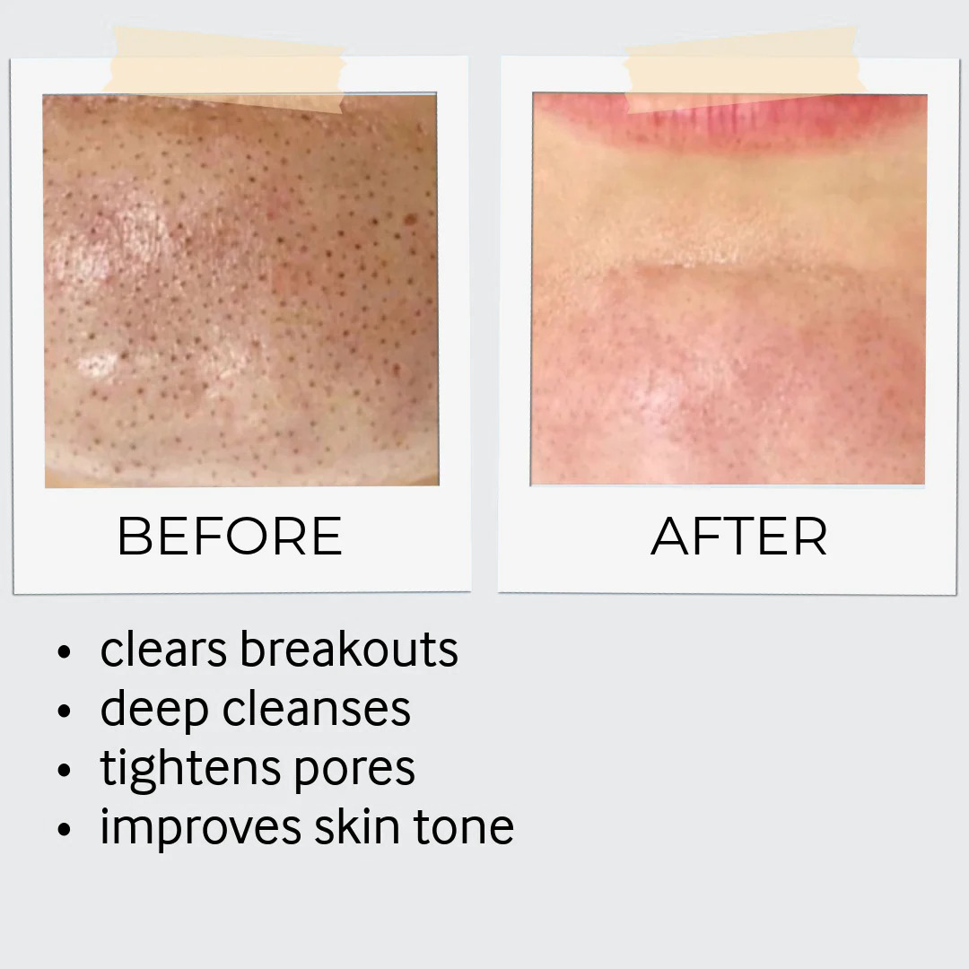 Exfoliation Bundle