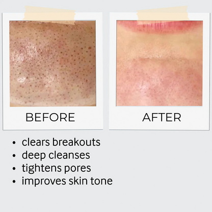 Exfoliation Bundle