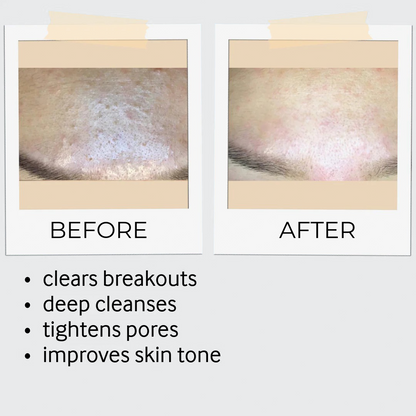 Exfoliation Bundle
