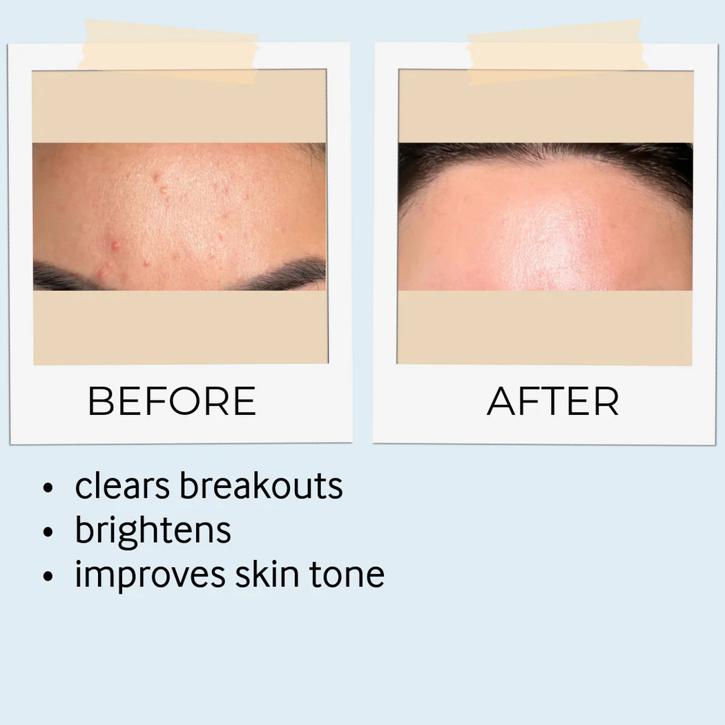 Acne Care Bundle