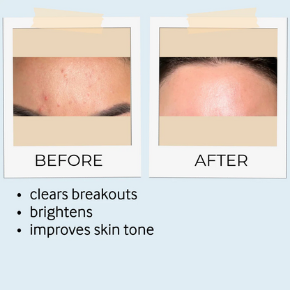 Acne Care Bundle