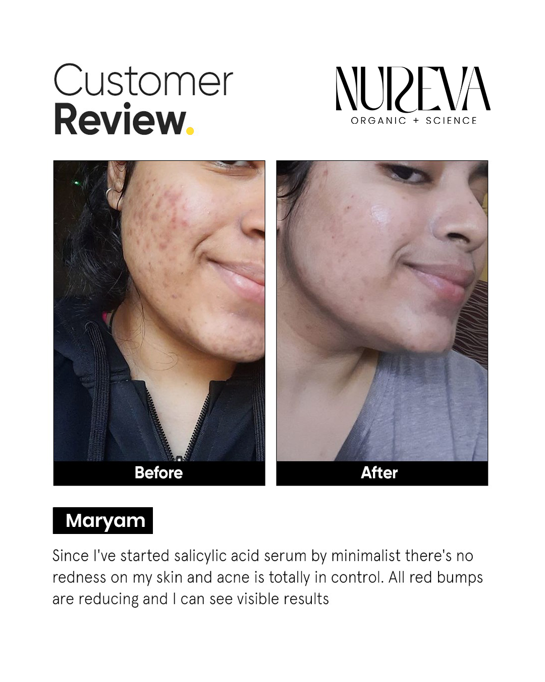 Anti Acne Serum